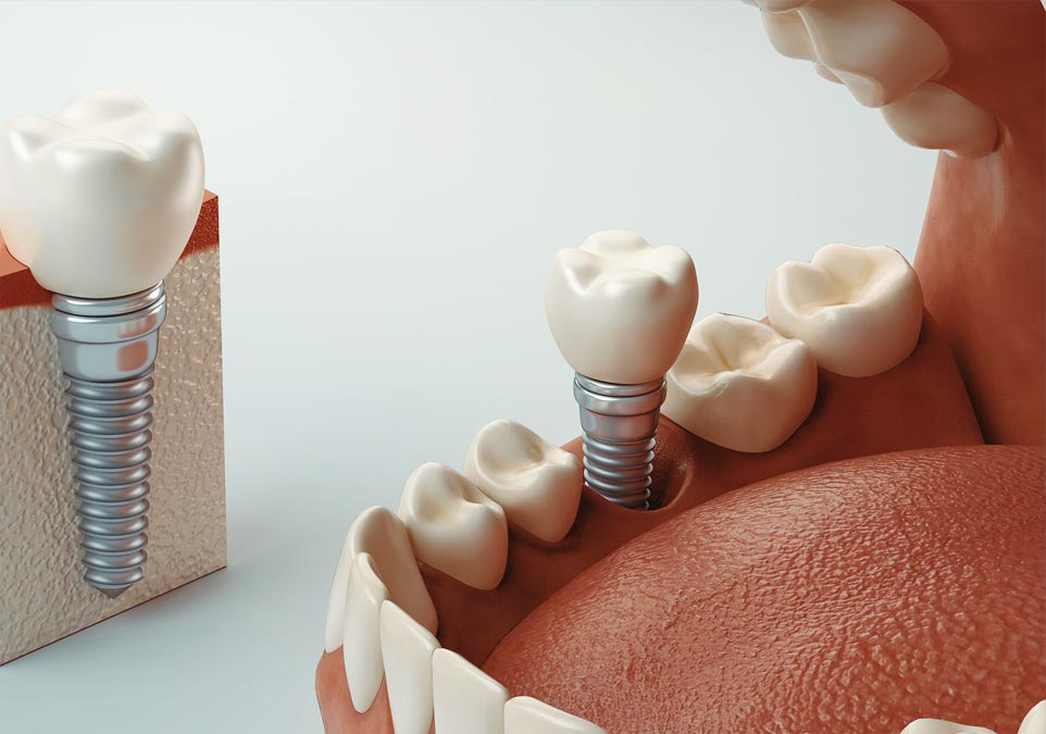 Dental Implants Image