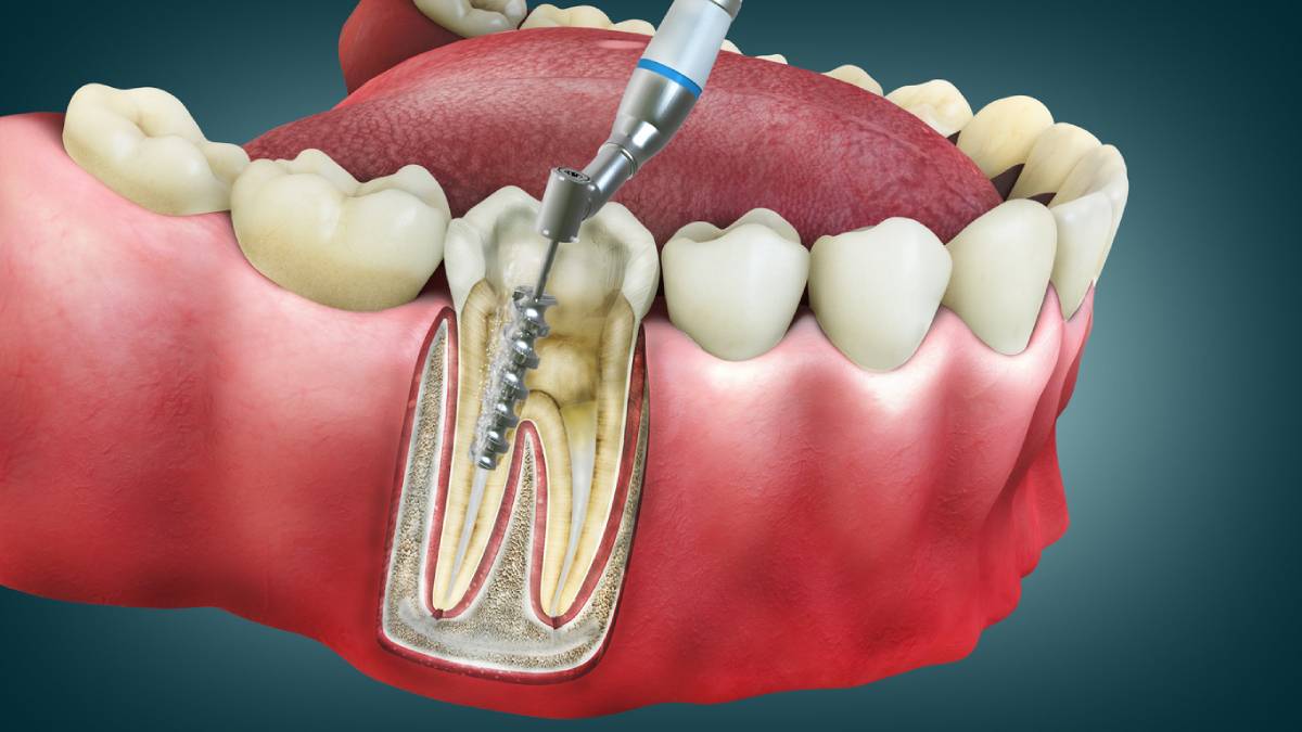 Featured image for How Long Does a Root Canal Procedure Take?
